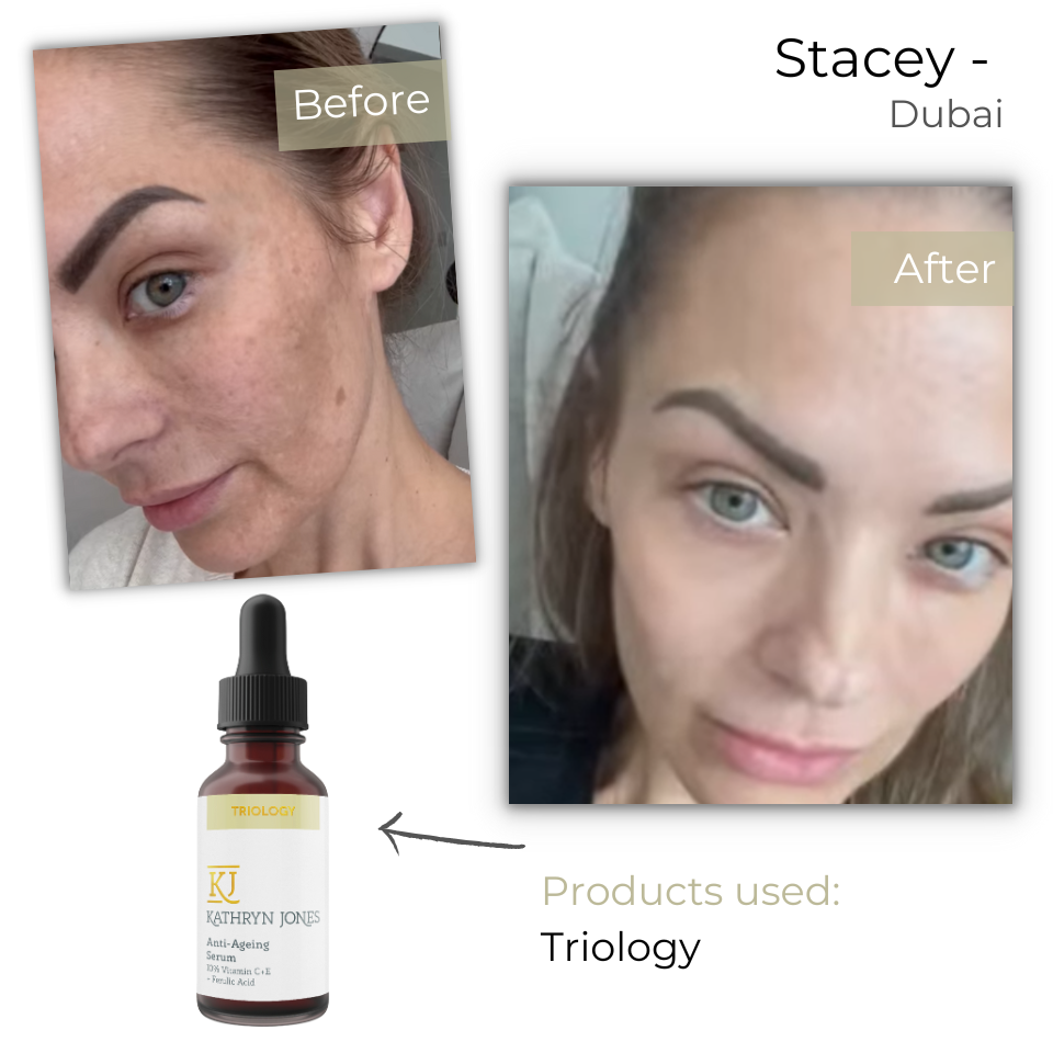 Before & After Photos of Stacey from Dubai - KJ Serums Reviews and results. Triology for beautiful Skin and Beauty