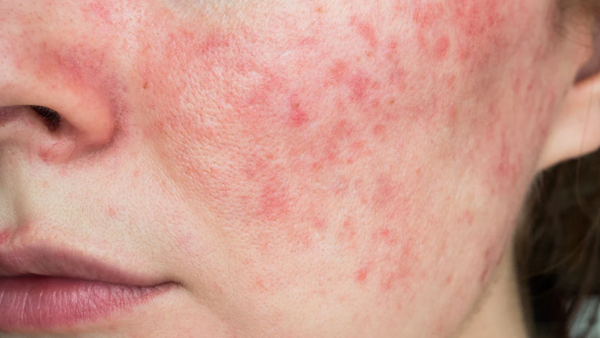 Close-up of irritated, red, flaky skin showing signs of a weakened skin barrier