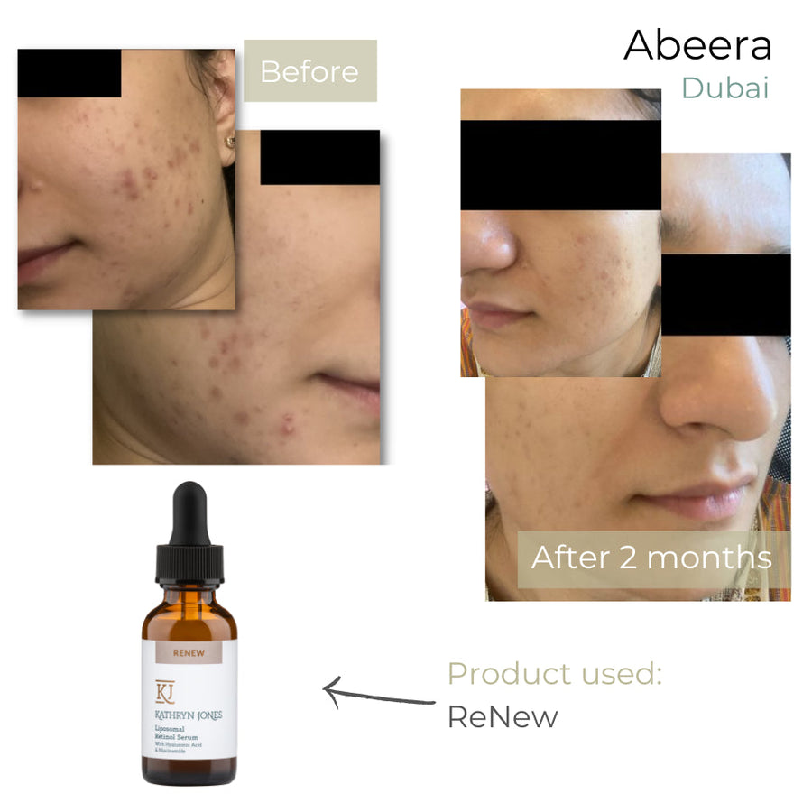 Abeera before and after skincare results