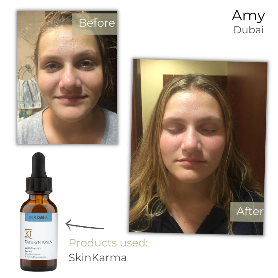 Amy before and after skincare results