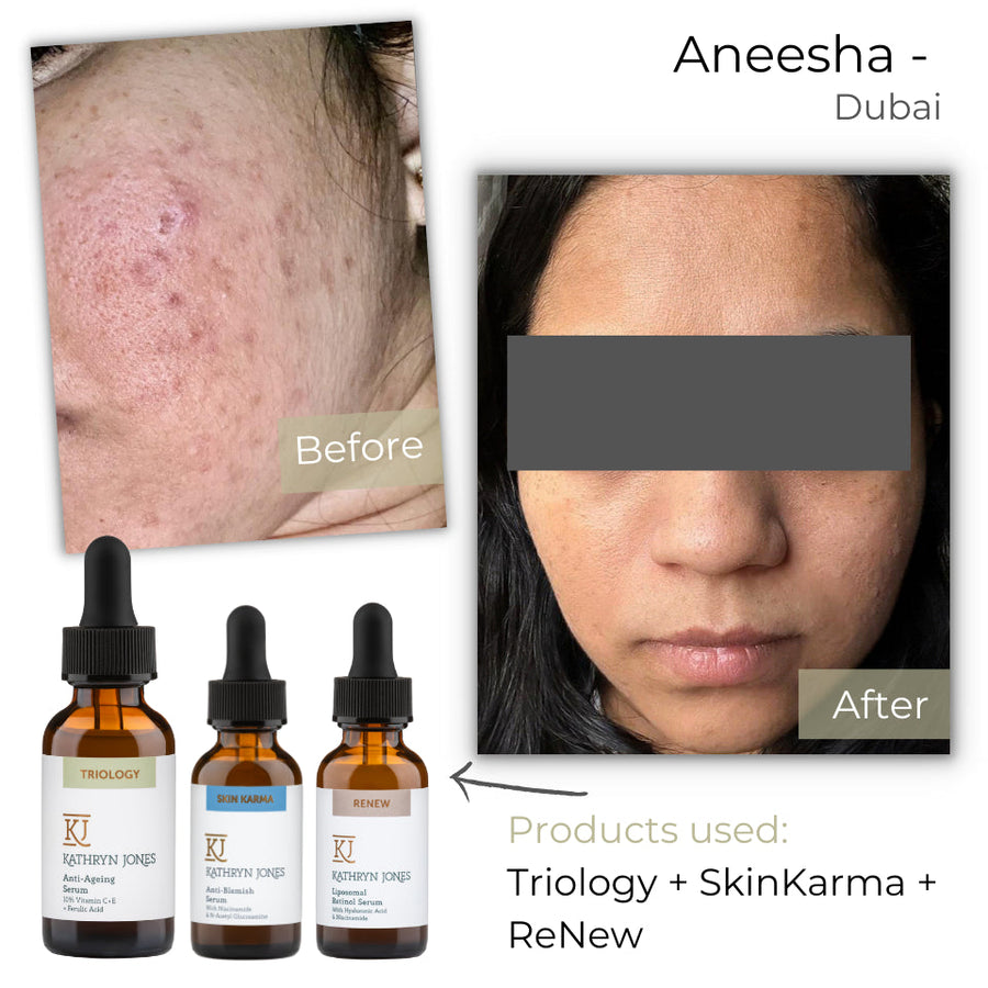 Aneesha before and after skincare results