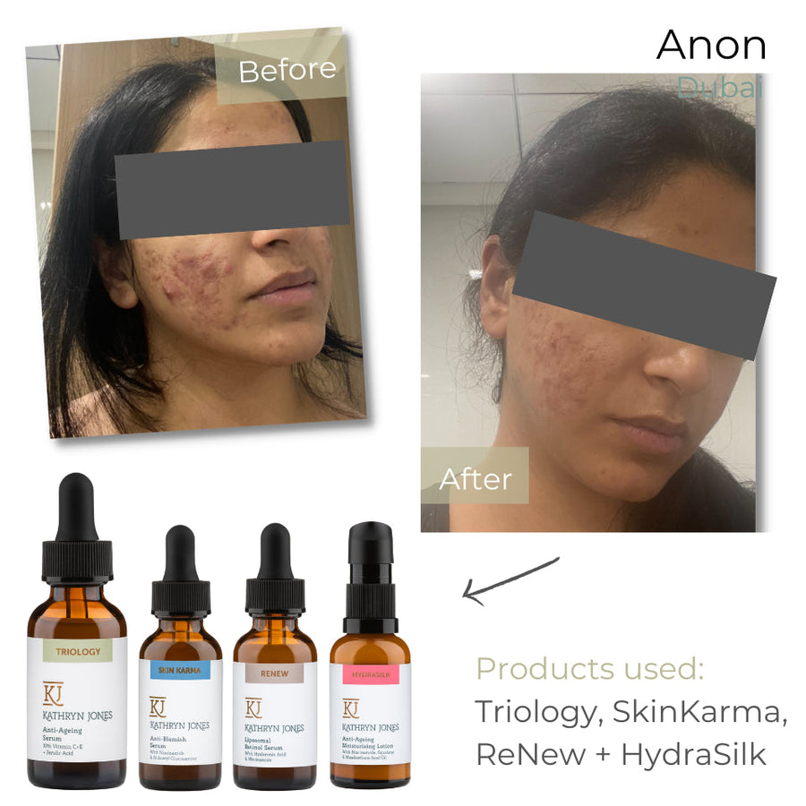 Anonymous before and after skincare results