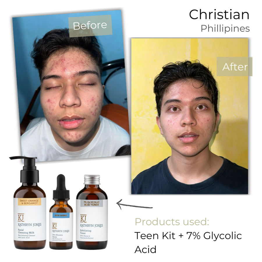 Christian (Front View) before and after skincare results