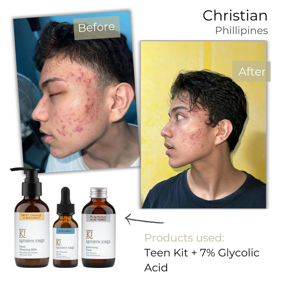 Christian (Side View) before and after skincare results