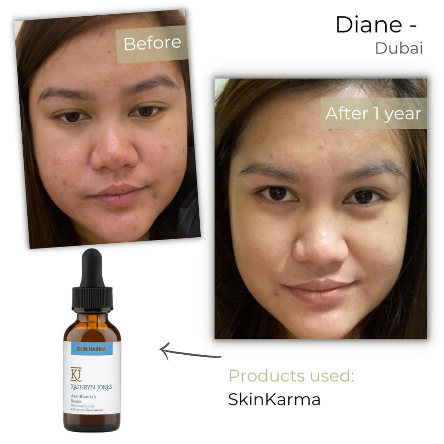 Diane before and after skincare results