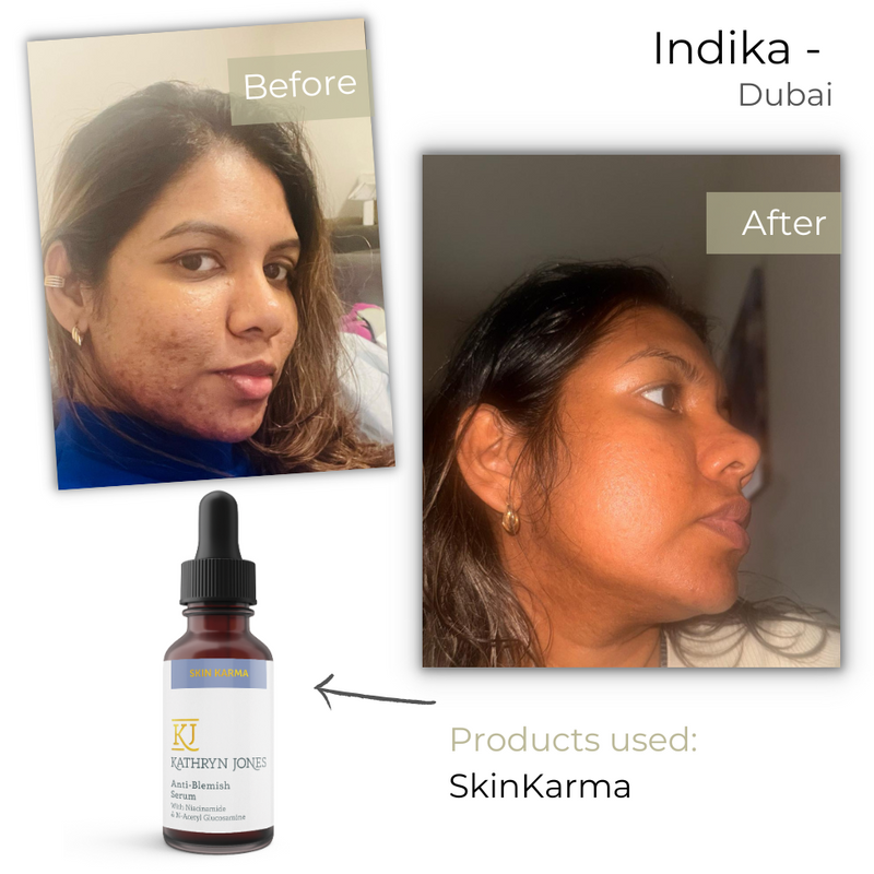 Before & After Photos of Indika from Dubai - KJ Serums Reviews and results. Skin Karma for clear skin and Beauty