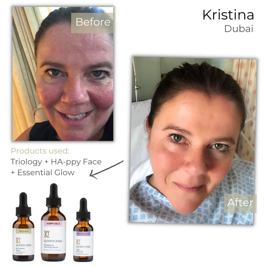 Kristina before and after skincare results