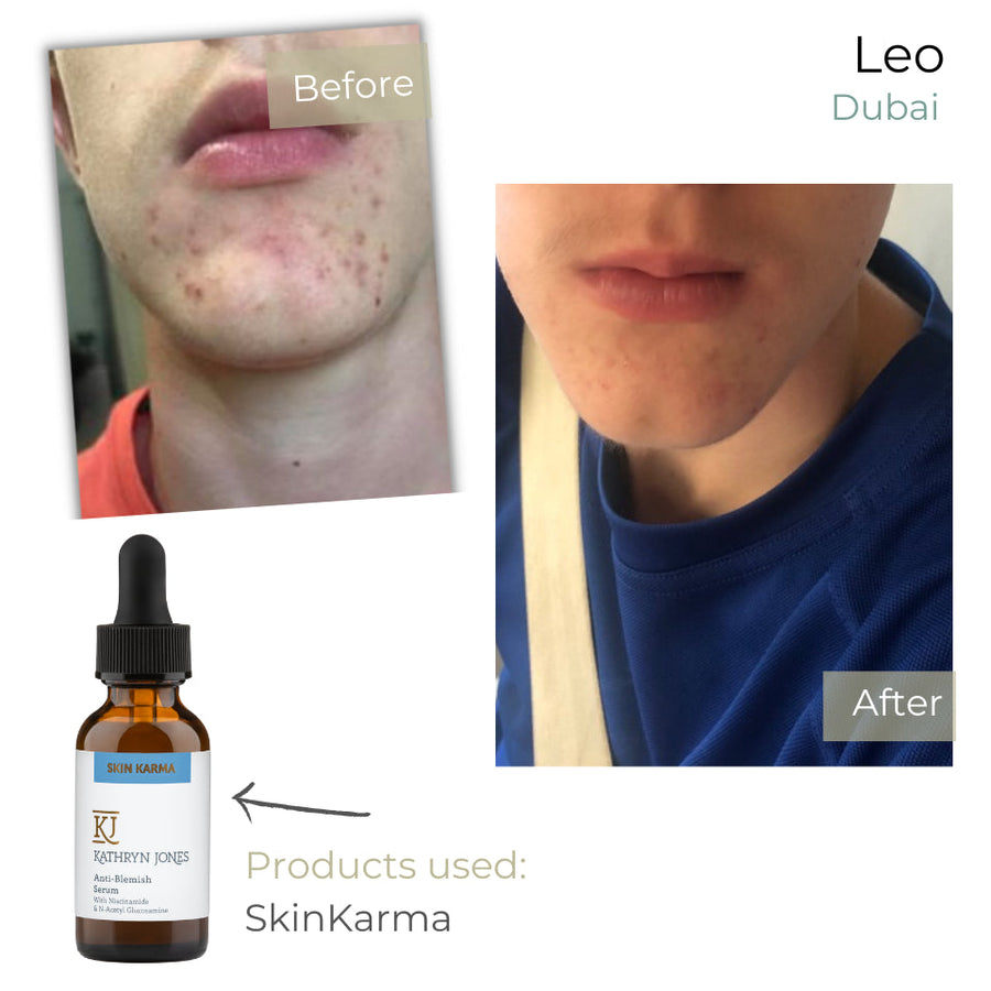 Leo before and after skincare results