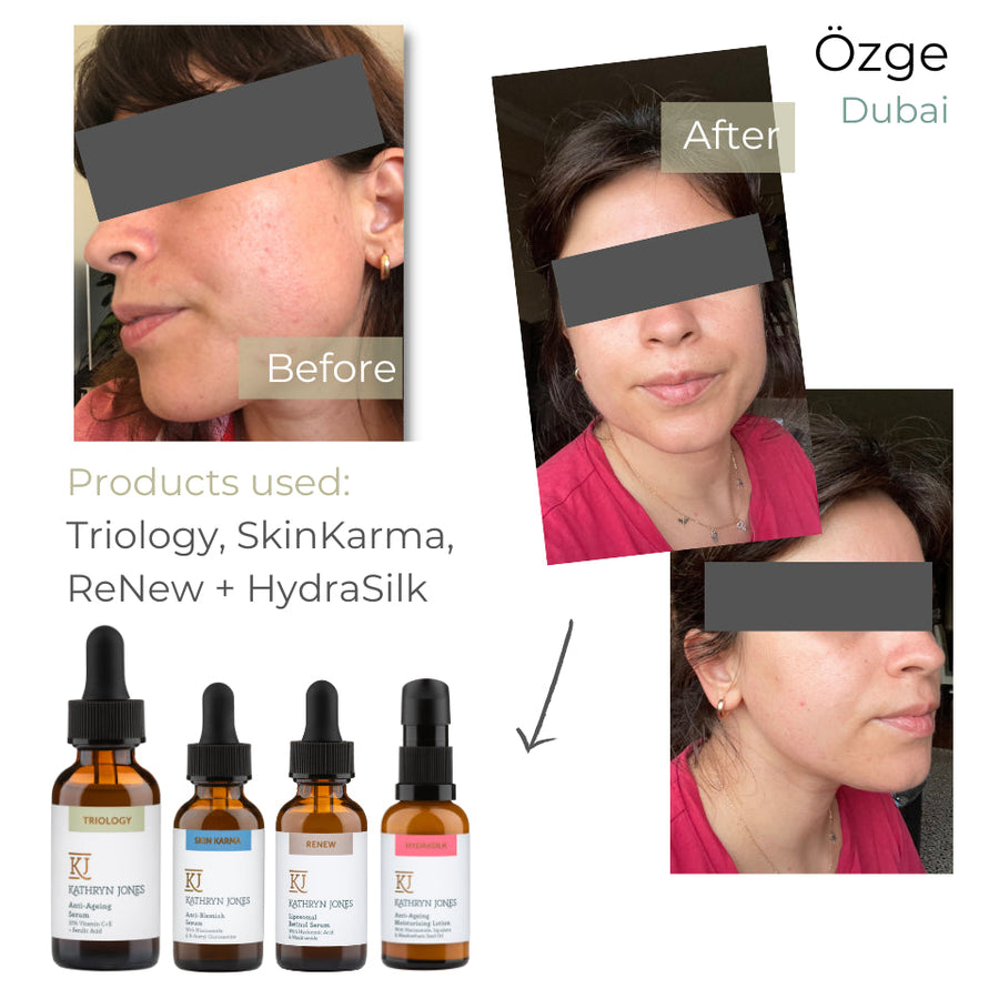 Ozge before and after skincare results