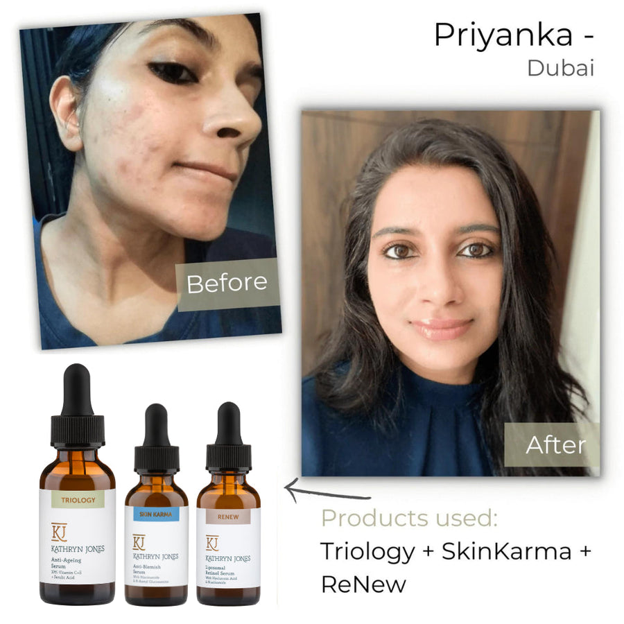 Priyanka before and after skincare results