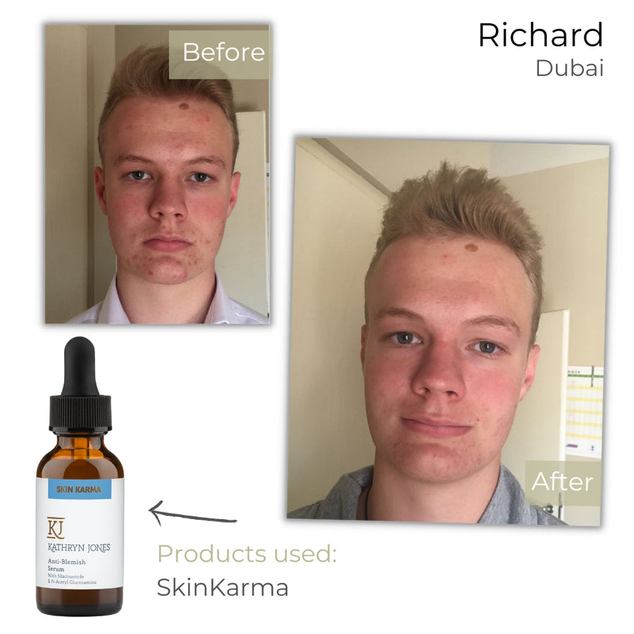 Richard before and after skincare results
