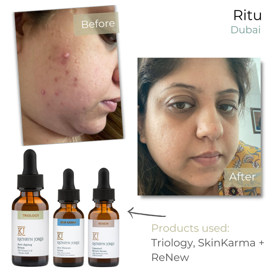 Ritu before and after skincare results