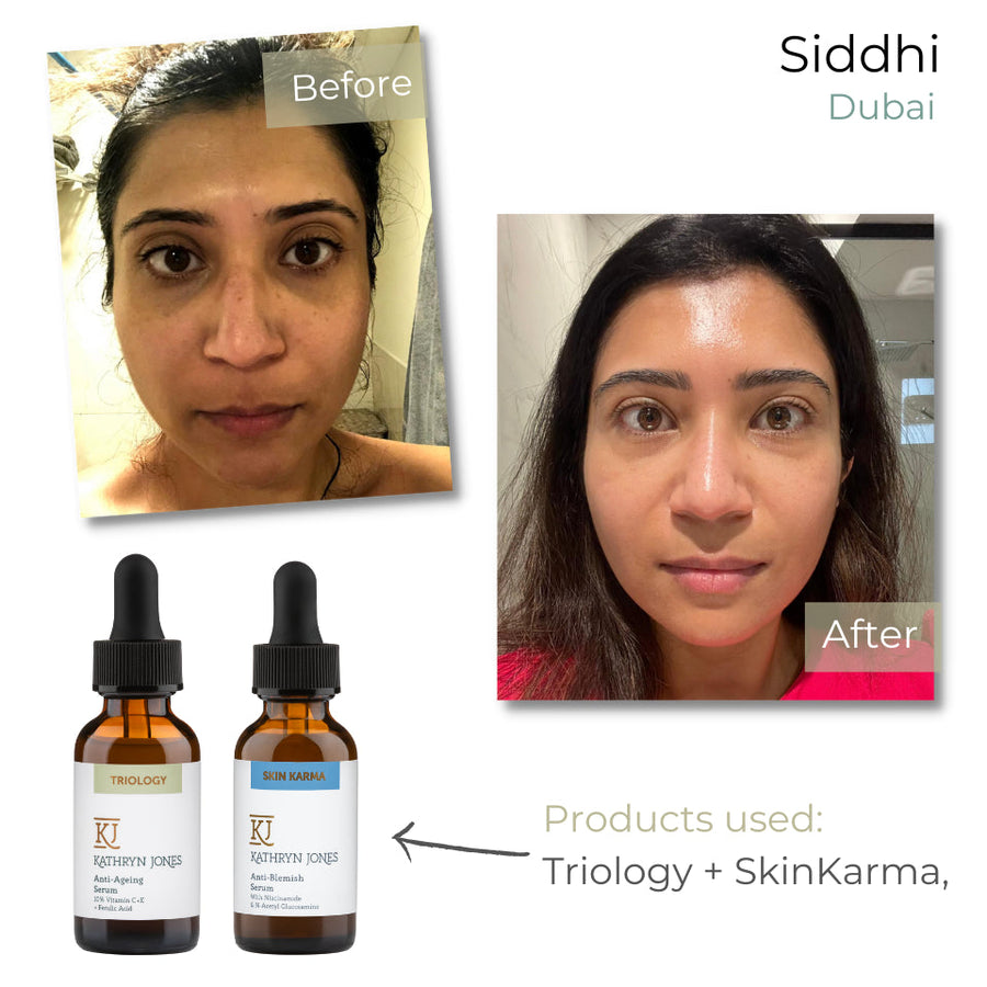 Siddhi before and after skincare results