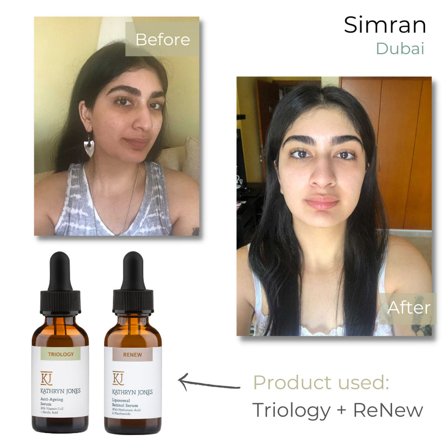 Simran before and after skincare results
