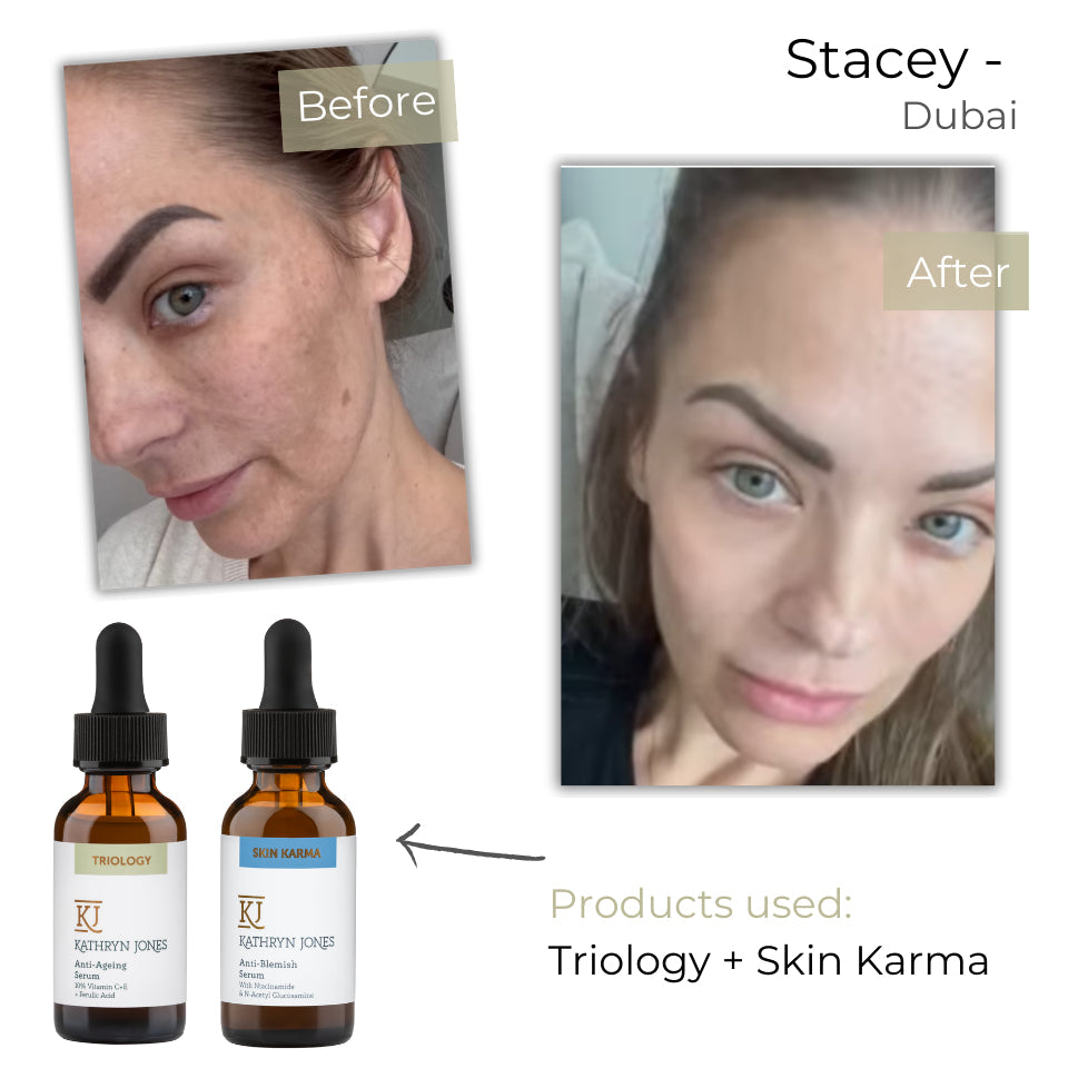 Before and after skin comparison photos of a woman labeled Stacey in Dubai, with two amber dropper bottles of skincare products at the bottom labeled Trilogy and Skin Karma, and text reading 'Products used: Trilogy + Skin Karma'.
