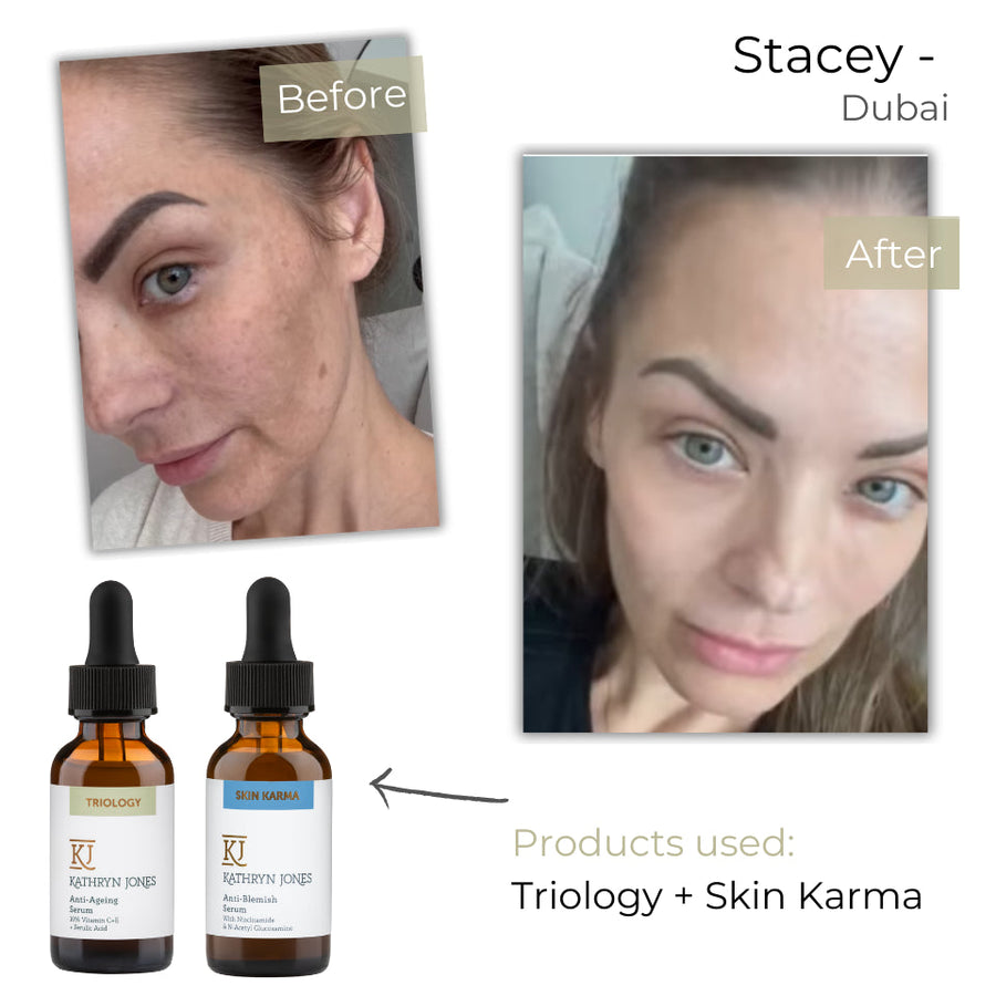 Stacey before and after skincare results