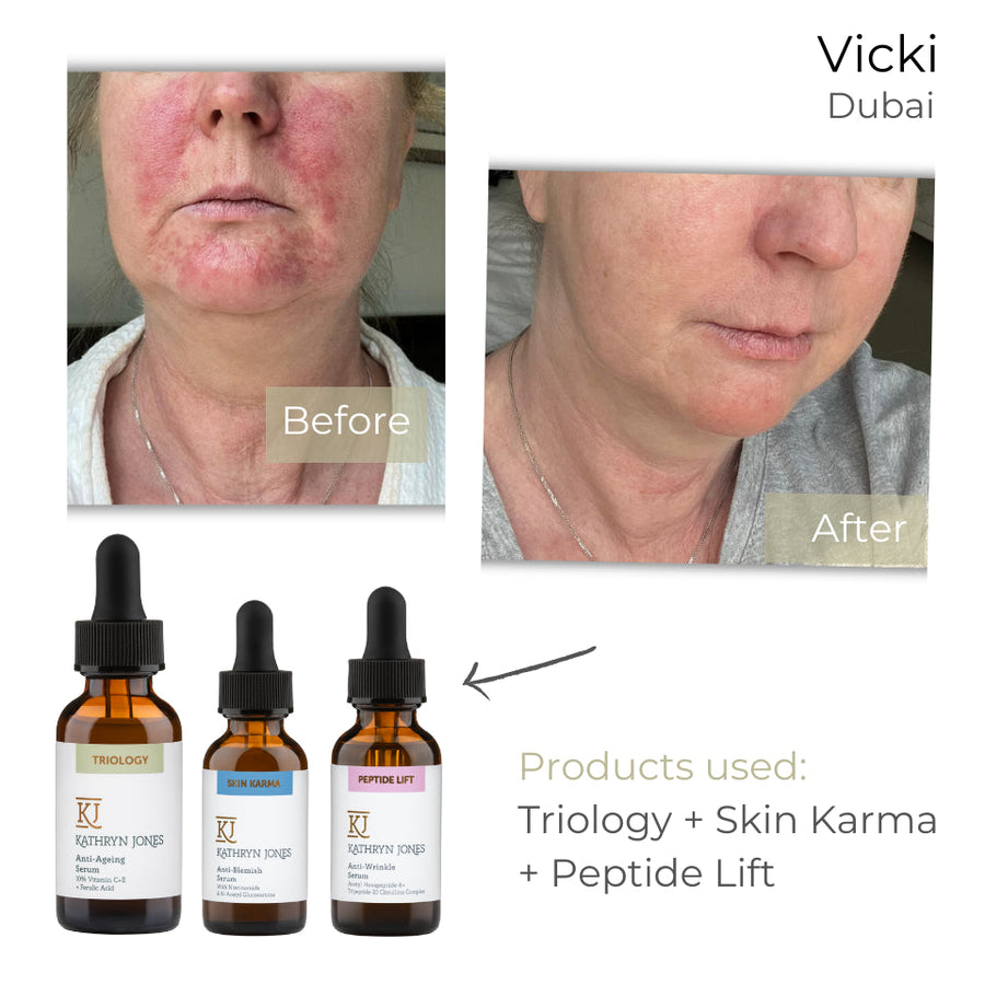 Vicki before and after skincare results